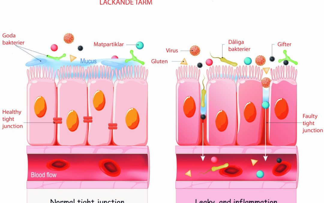 Vad är “läckande tarm”?